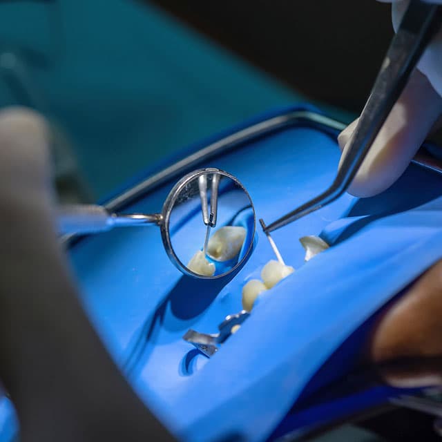 Tratamiento de endodoncia en clínica dental en Vigo C Dovaz