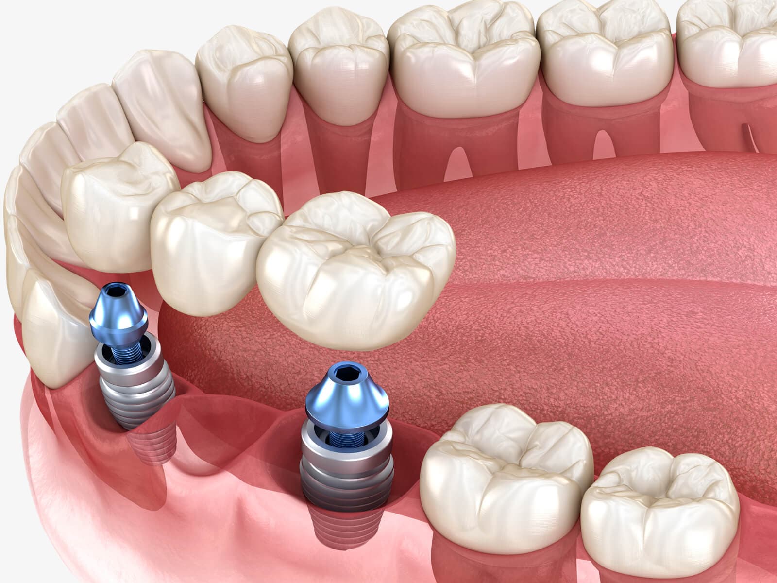 Precio Implantes dentales en Vigo
