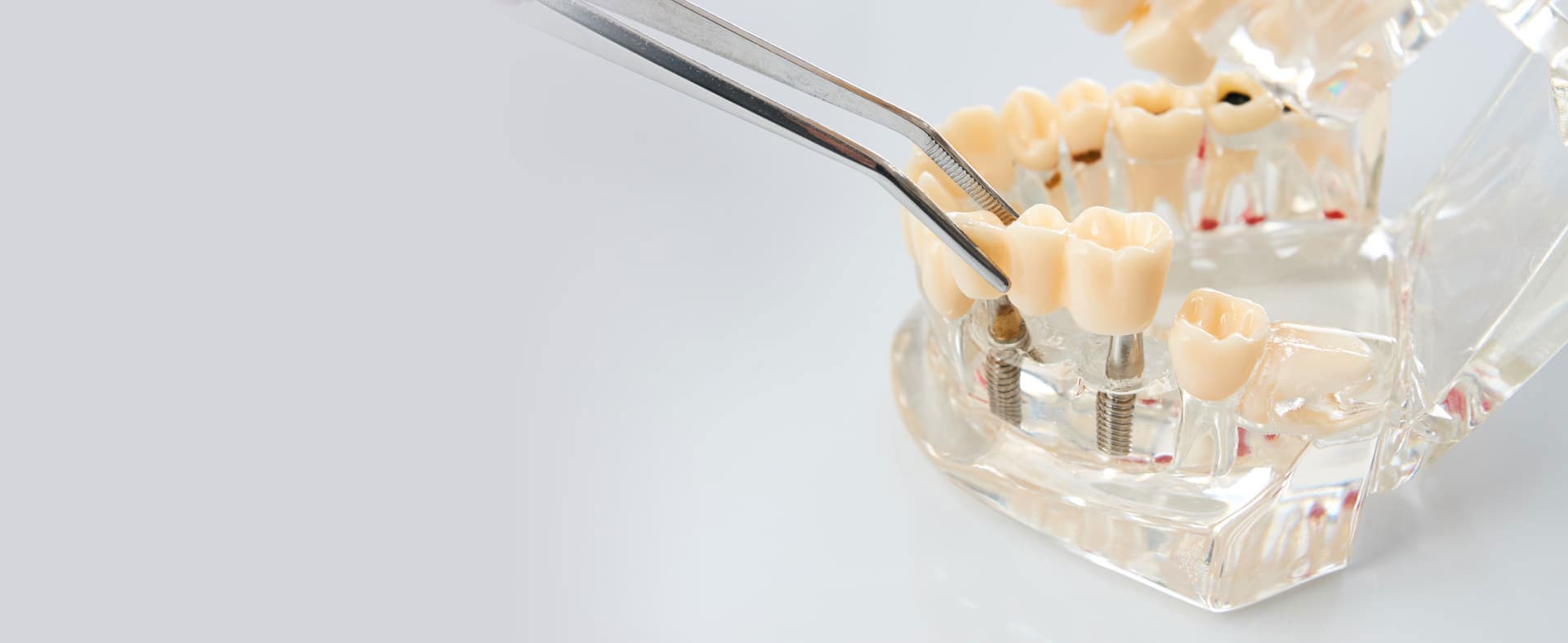 Implantes dentales en Vigo